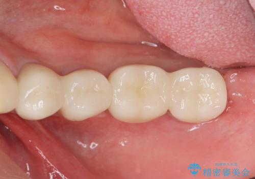 銀歯を外し、インプラントを入れたいの治療後