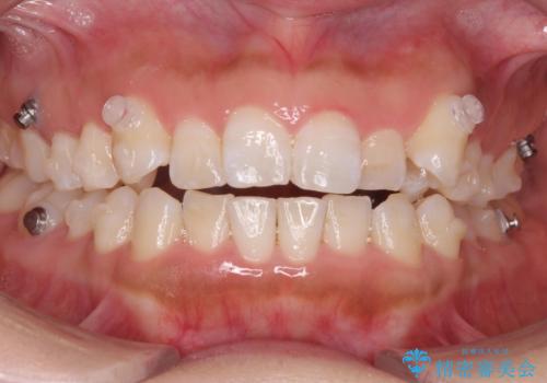八重歯を非抜歯で マウスピースで治療 奥歯を後ろに下げてすき間を確保の治療中