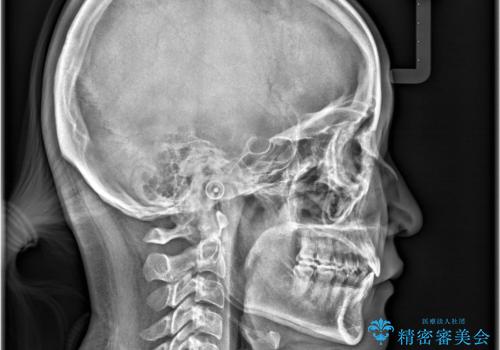 【インビザライン、10ヵ月で矯正終了!】下の前歯が斜めになっているのを治したい!の治療後