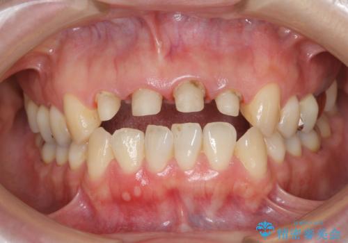 黒っぽい歯ぐきを改善したい　メタルフリーセラミック治療の治療中