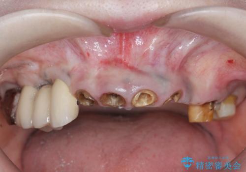 [ 精密セラミック治療 ]  前歯の破折 根尖病変　の治療前