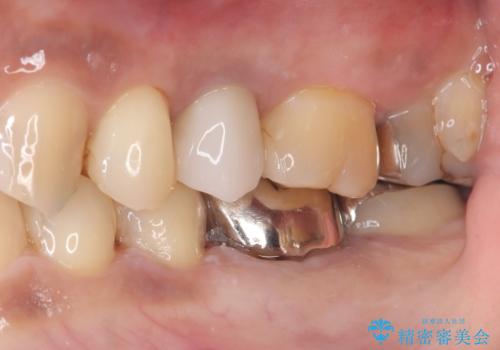 【セラミックインレー】銀の詰め物を白くしていきたいの治療後