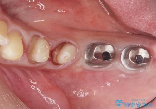 銀歯を外し、インプラントを入れたいの治療中