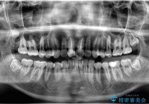【ワイヤー矯正 11ヵ月で矯正終了!】歯のでこぼこを治したい! の治療前