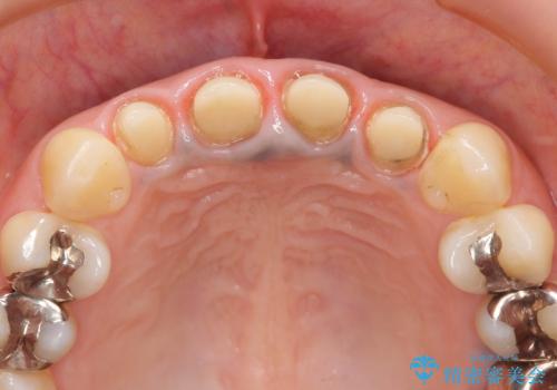 黒っぽい歯ぐきを改善したい　メタルフリーセラミック治療の治療中