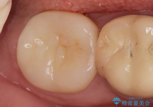 割れたセラミック下に再発した虫歯の症例 治療後