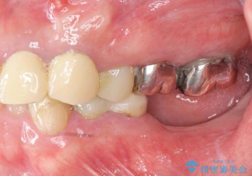 銀歯を外し、インプラントを入れたいの症例 治療前
