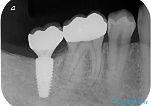 銀歯を白くしたい。(インプラント治療)の治療後