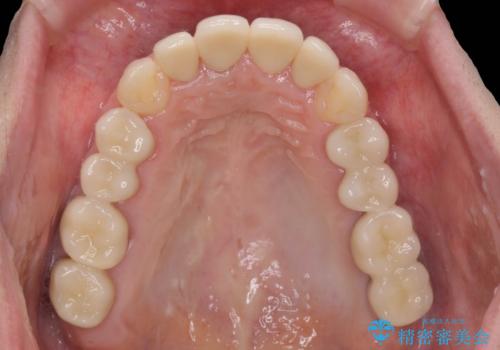 インプラント・セラミック・矯正治療を含む包括歯科診療の治療後