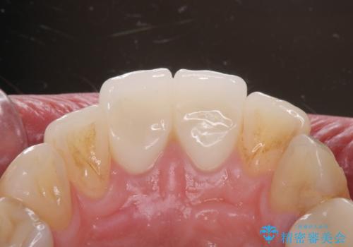 変色した歯を綺麗にしたい 根管治療からジルコニアクラウンでの修復の治療後