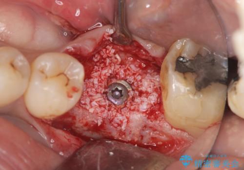 失った奥歯をインプラントで機能回復の治療中