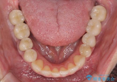 インプラント・セラミック・矯正治療を含む包括歯科診療の治療後