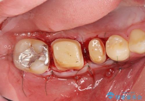 深い虫歯 セラミッククラウンの精度を高める歯周外科手術の治療中