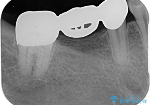 金属のブリッジをやり替えたいの治療前