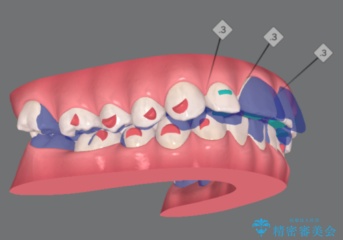 突きでた前歯 マウスピース矯正で改善