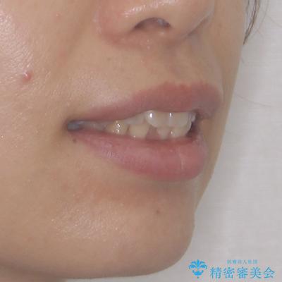 くちばしのような前歯 抜歯矯正で口を閉じやすくの治療前(顔貌)