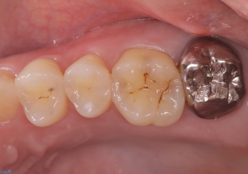 歯並びも綺麗になったし歯も白くしたいの症例 治療前