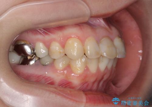 インプラント・セラミック・矯正治療を含む包括歯科診療の治療前