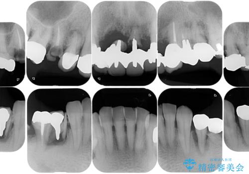 孫から口臭を指摘され来院、全顎治療で噛み合わせ、見た目、口臭全て劇的改善!の治療前