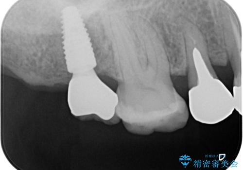 [ 歯槽堤保存術 ] [ 奥歯の破折 ]  ソケットプリザベーションを併用したインプラント治療