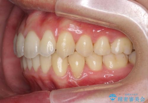 過蓋咬合・上顎前突・叢生を改善するマウスピース矯正の治療後