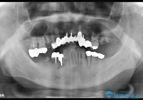 孫から口臭を指摘され来院、全顎治療で噛み合わせ、見た目、口臭全て劇的改善!の治療前