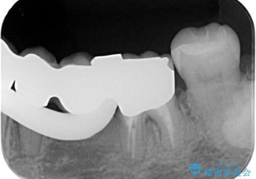 【セラミックインレー】詰め物が外れたので綺麗にしたいの治療後