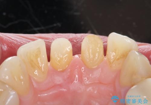 変色した歯を綺麗にしたい 根管治療からジルコニアクラウンでの修復の治療中