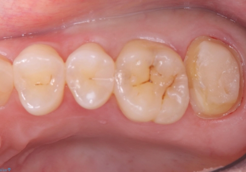 歯並びも綺麗になったし歯も白くしたいの治療中