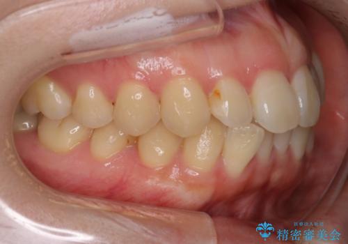 前歯のガタツキをインビザラインで改善の治療前