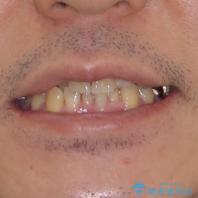 激痛の奥歯のむし歯治療 折角なので矯正治療もしたいの治療前(顔貌)