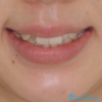 目立たない裏側装置でデコボコをきれいに解消の治療前(顔貌)