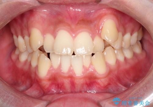 【抜歯矯正】クリア装置で1年半の症例 治療前