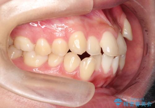 【抜歯矯正】クリア装置で1年半の治療前