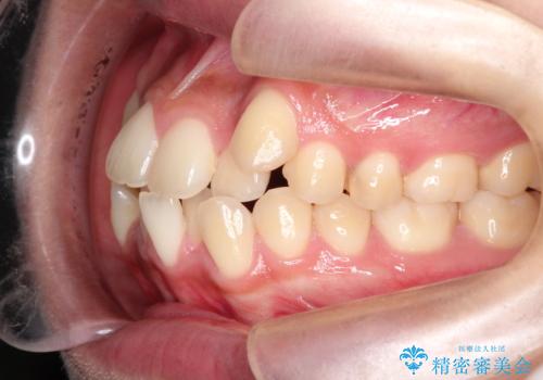 【抜歯矯正】クリア装置で1年半の治療前