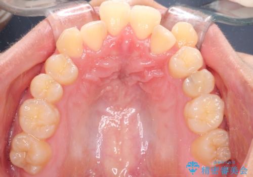 【抜歯矯正】クリア装置で1年半の治療前
