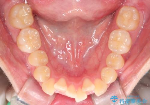 【抜歯矯正】クリア装置で1年半の治療前