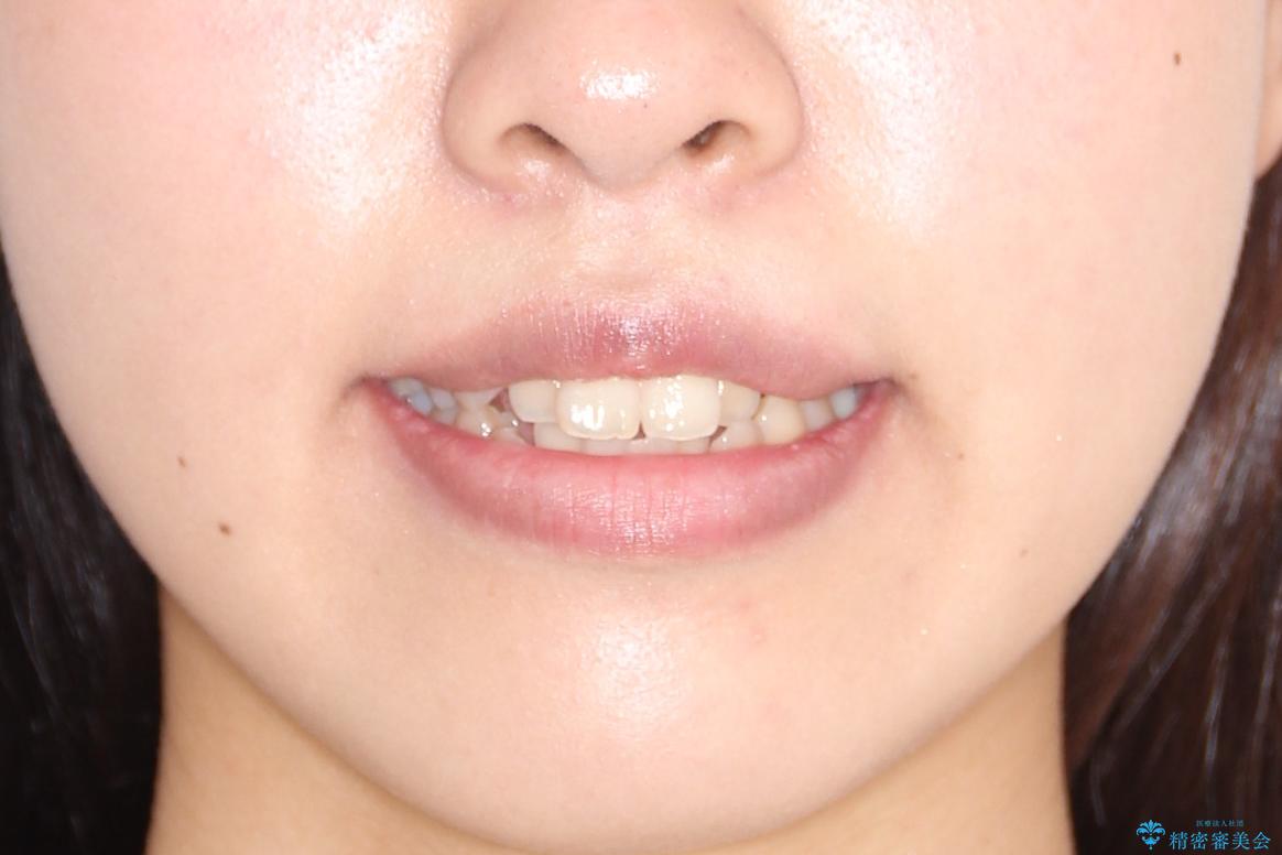 【抜歯矯正】クリア装置で1年半の治療前(顔貌)