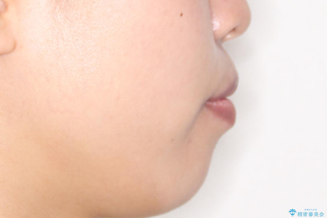 【抜歯矯正】クリア装置で1年半の治療前(顔貌)