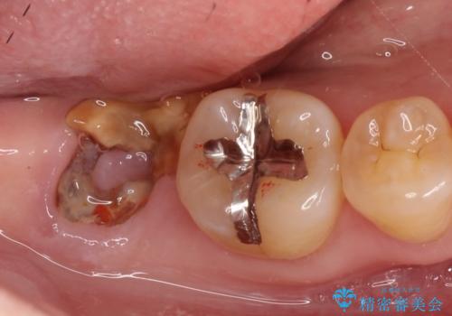 【インプラント】虫歯が大きくて歯を抜いた。の治療前