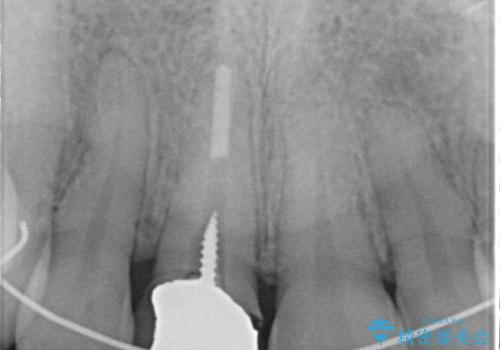 前歯をきれいなセラミックにしたい。の治療前