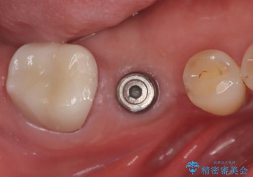 【インプラント】奥歯でしっかり物を噛みたい。の治療中