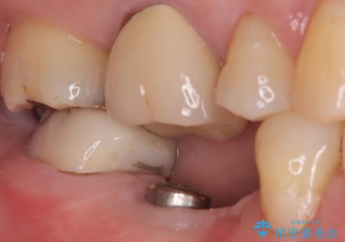 【インプラント】奥歯でしっかり物を噛みたい。の治療中