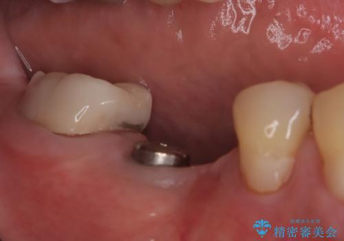 【インプラント】奥歯でしっかり物を噛みたい。の治療中