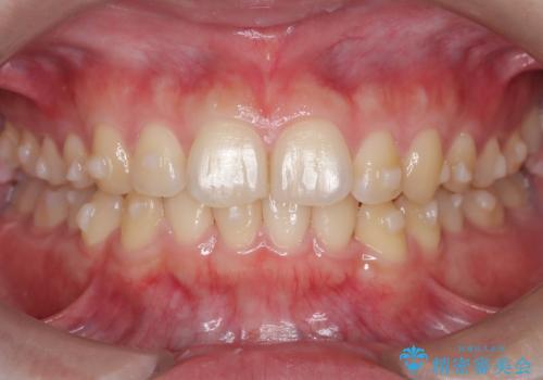 マウスピース矯正で前歯のガタツキを改善!　短期間で治療完了の治療中