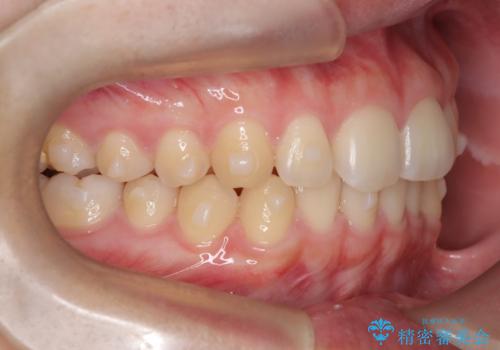 マウスピース矯正で前歯のガタツキを改善! 短期間で治療完了の治療中