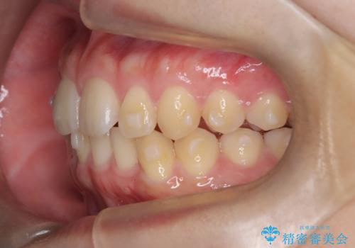 マウスピース矯正で前歯のガタツキを改善!　短期間で治療完了の治療中