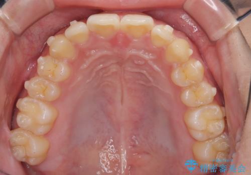マウスピース矯正で前歯のガタツキを改善! 短期間で治療完了の治療中