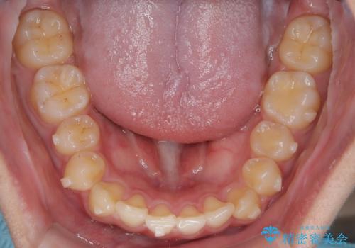 マウスピース矯正で前歯のガタツキを改善! 短期間で治療完了の治療中