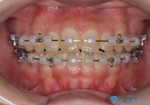 【抜歯矯正】クリア装置で1年半の治療中